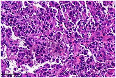 An unusual cause of significantly elevated blood alpha-fetoprotein levels: a case report and literature review